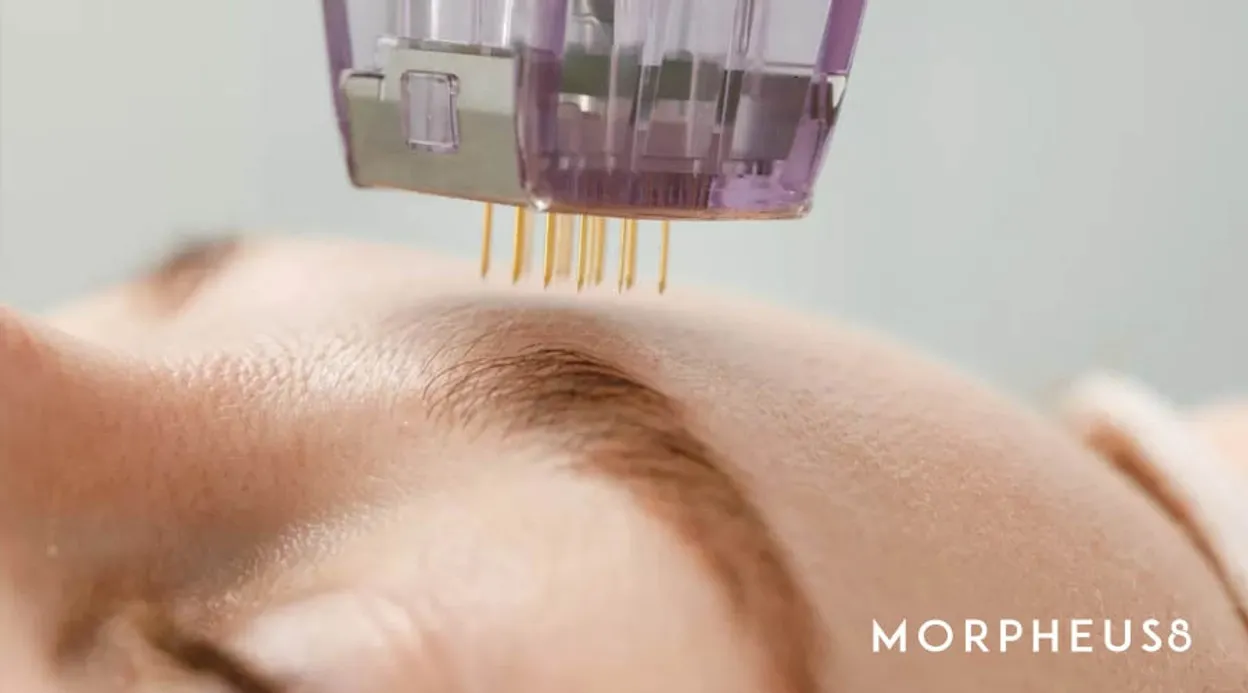 Gold-coated needles extended from a treatment tip above a woman’s forehead