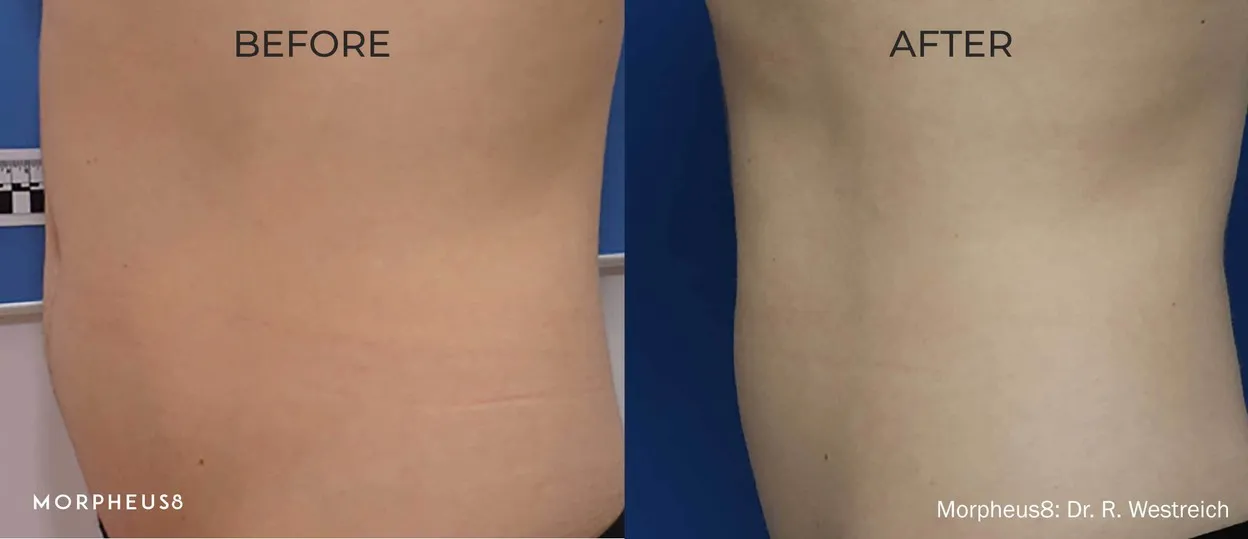 Before and after comparison of a woman’s abdomen and flank, manufacturer image, treatment by Dr R. Westreich