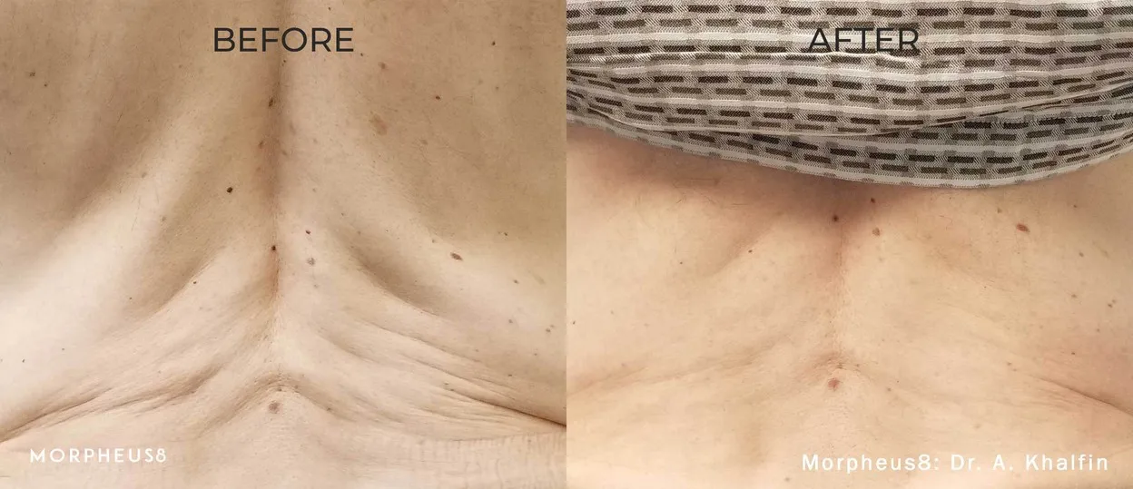 Before and after comparison of the skin on a woman’s upper chest, manufacturer image, treatment by Dr A. Khalfin