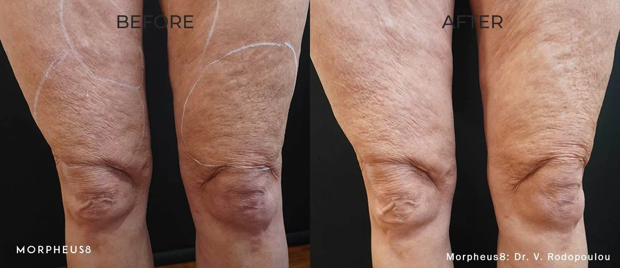 Before and after comparison of a woman’s knees and thighs, manufacturer image, treatment by Dr V. Rodopoulou