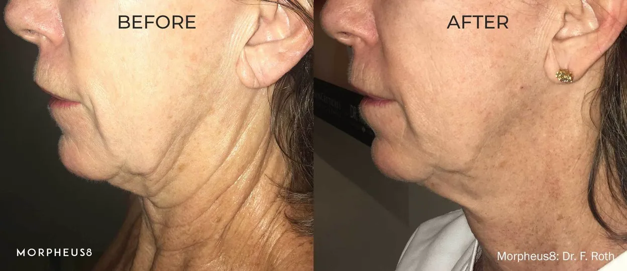 Before and after comparison of a woman’s jawline and neck, manufacturer image, treatment by Dr F. Roth