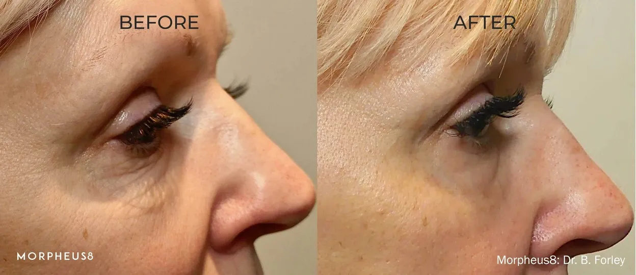 Before and after comparison of the skin around a woman’s eye, manufacturer image, treatment by Dr B. Forley
