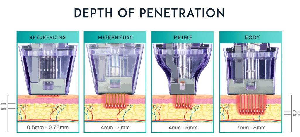 Diagram comparing the treatment depths of resurfacing, Morpheus8, Prime and Morpheus8 Body applicators