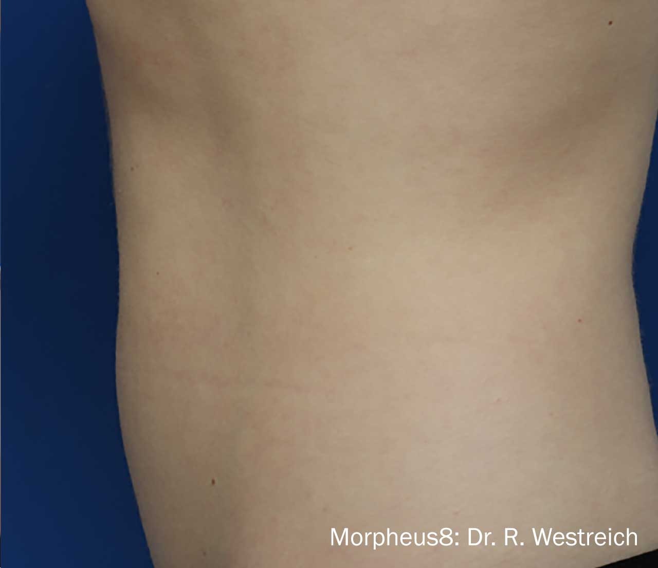 Abdomen after Morpheus8 treatment