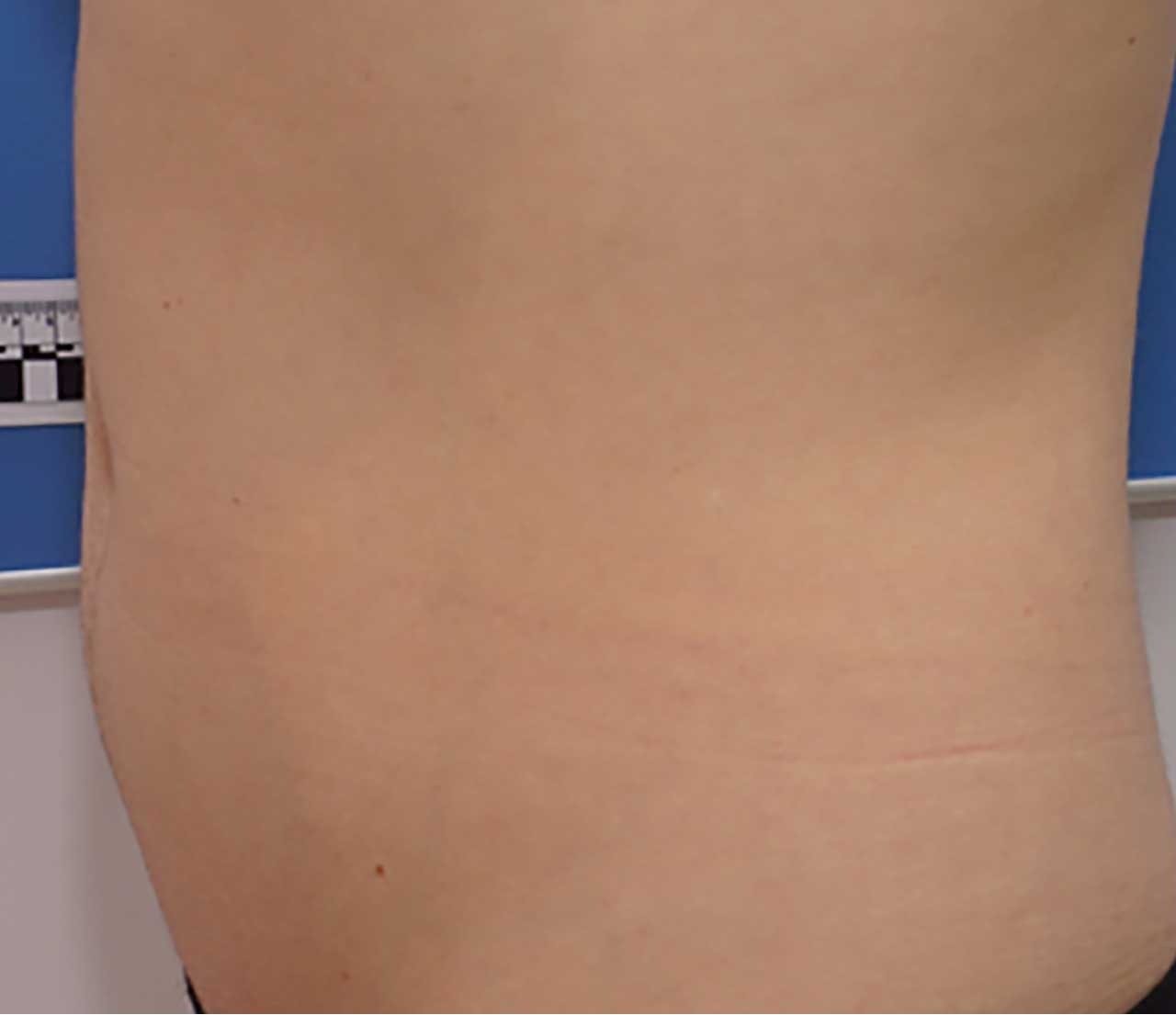 Abdomen before Morpheus8 treatment