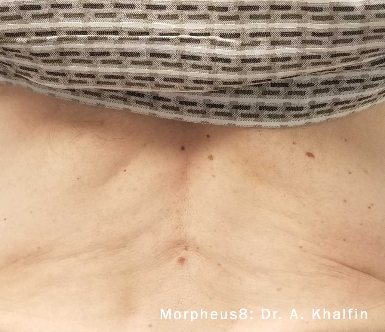 Back after Morpheus8 treatment