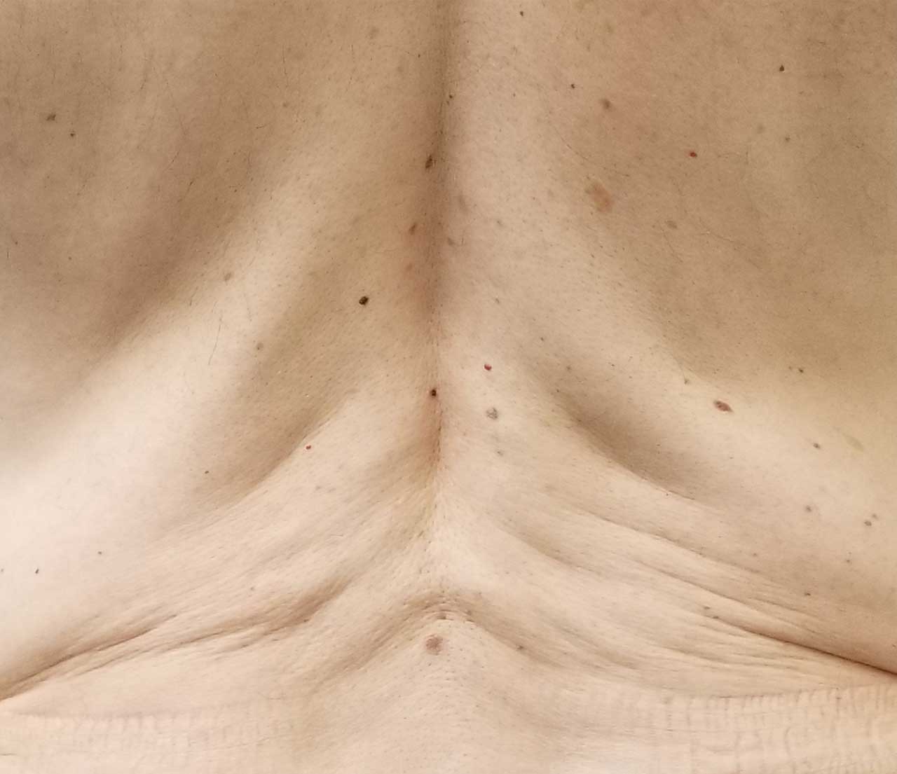Back before Morpheus8 treatment