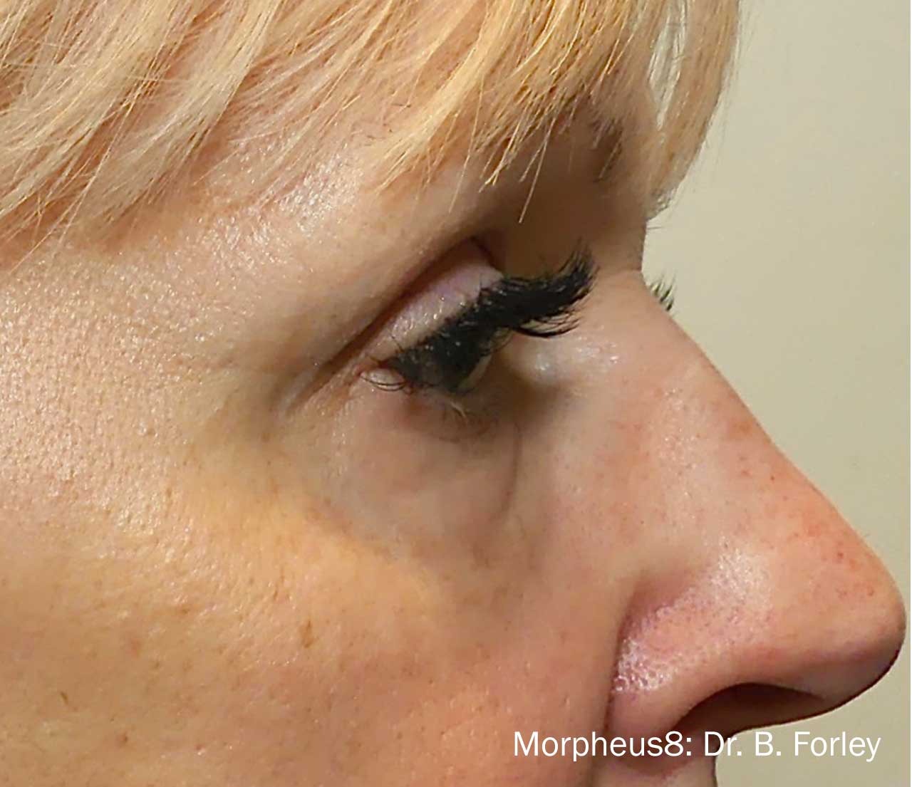Eye area after Morpheus8 treatment
