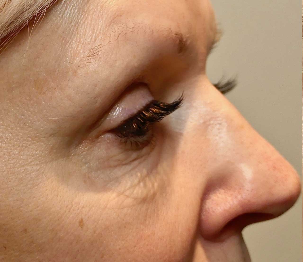 Eye area before Morpheus8 treatment