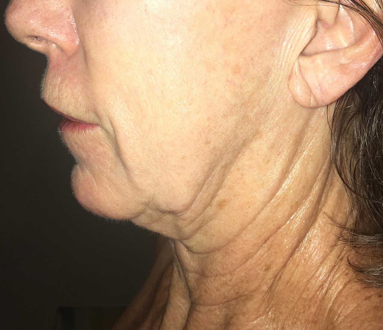 Face & neck before Morpheus8 treatment