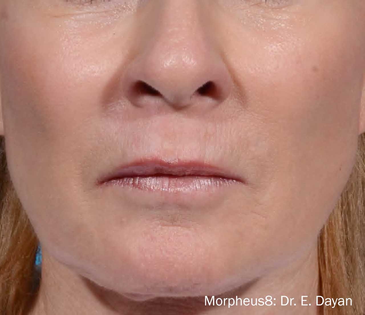 Lower face after Morpheus8 treatment