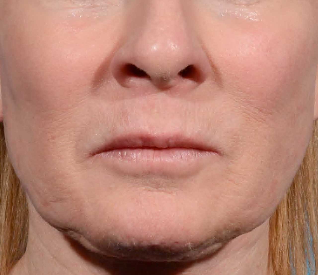 Lower face before Morpheus8 treatment