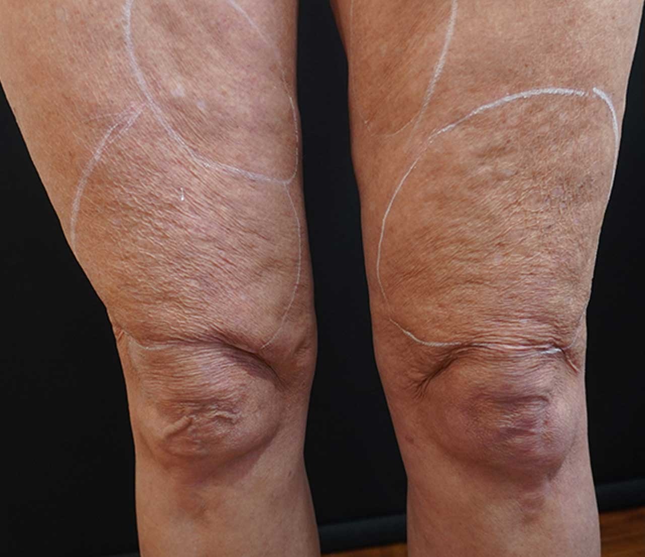 Thighs before Morpheus8 treatment